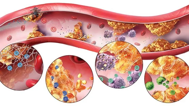 Rối loạn lipid máu liên quan đến cholesterol toàn phần, LDL, HDL và triglyceride