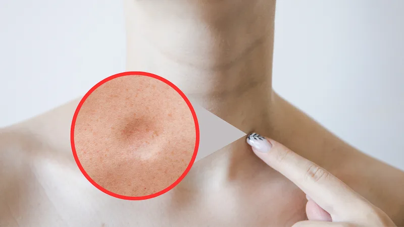 U mỡ là gì?
