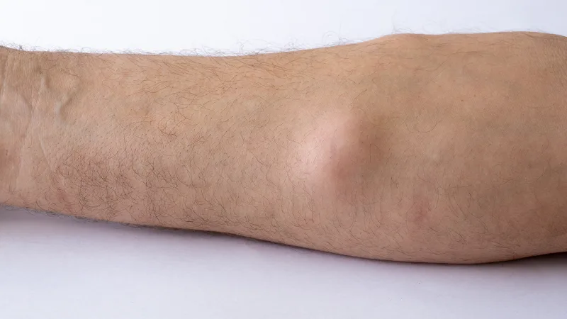 Cách phòng ngừa u mỡ